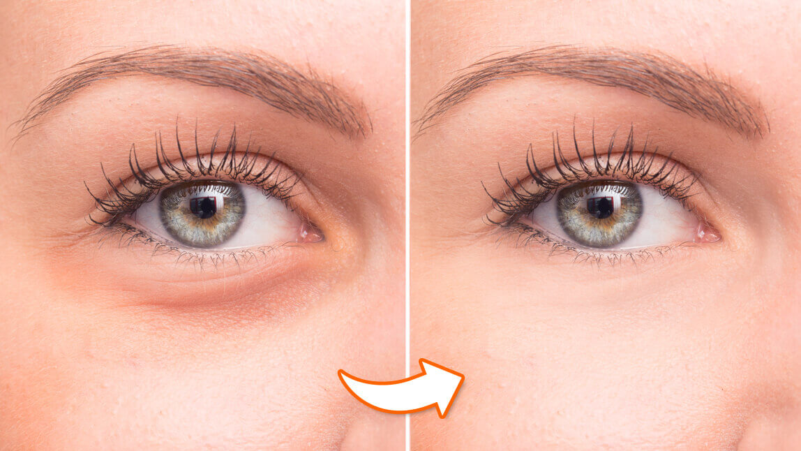 Wrinkle-Free Made Easy: The Rise of Laser Therapy in the U.S.