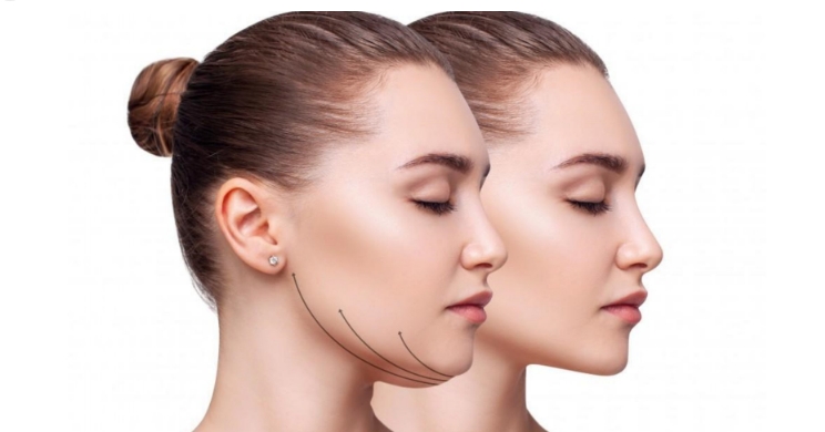 Laser Double Chin Treatment Process: From Preoperative Preparation to Postoperative Care