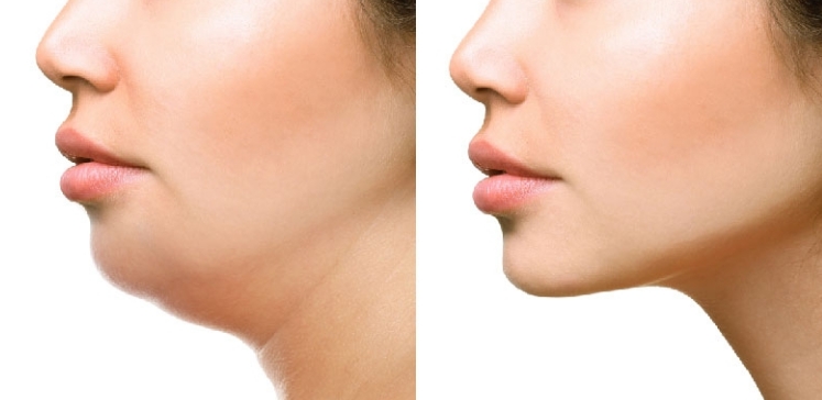Laser Solutions for Double Chin Contouring
